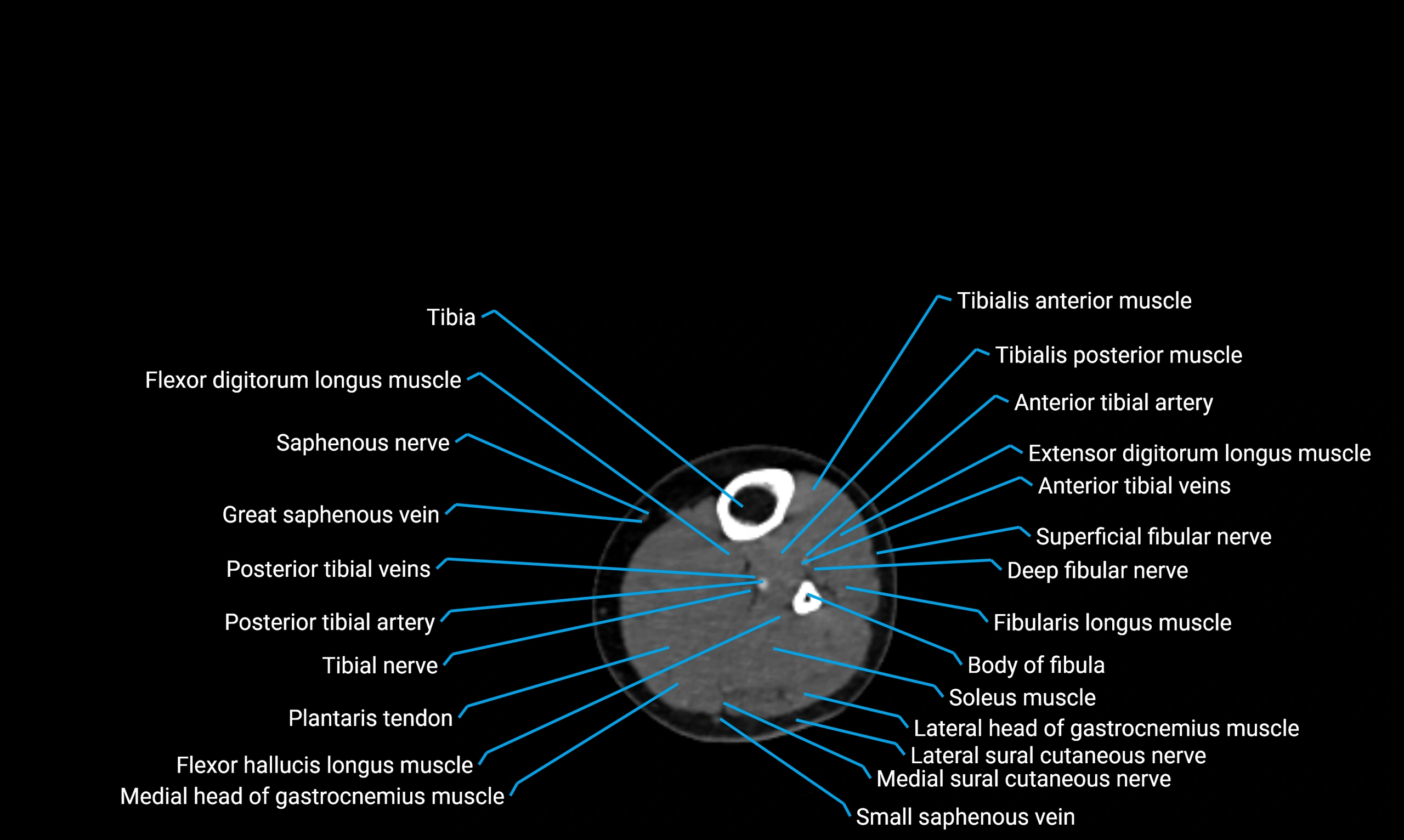 CT lower limb axial cross sectional anatomy labelled image 110 (2).webp